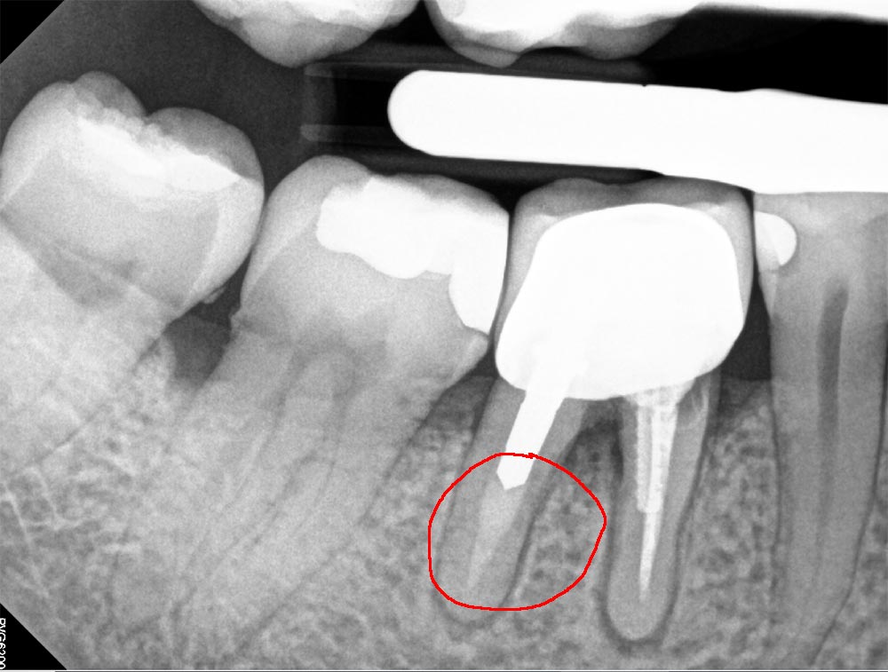 Root canal treatment gone wrong