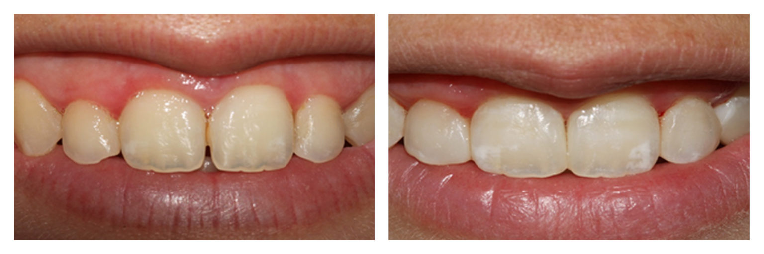 Diastemas Closure Baker Street Dental