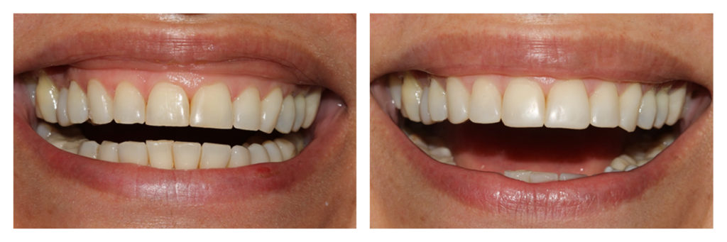 Incisal Edge - Baker Street Dental