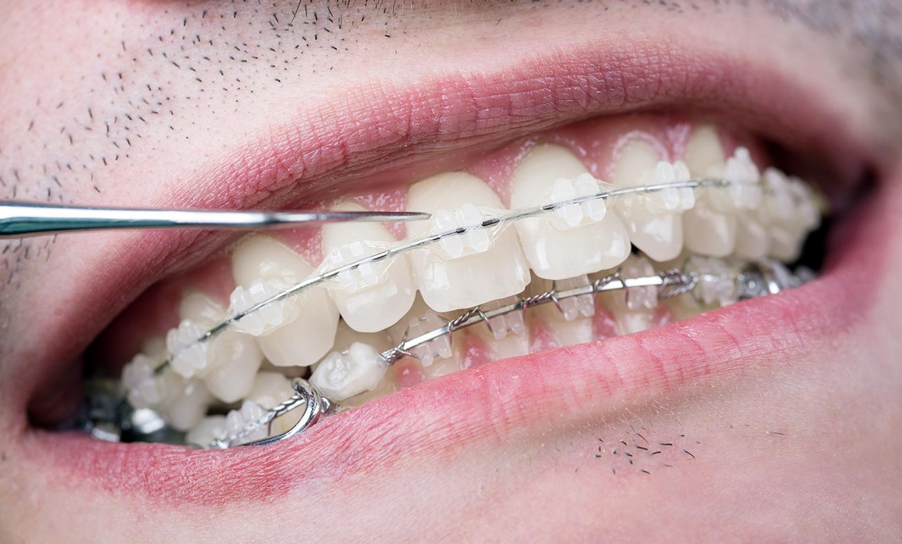 Clear Ceramic Braces Baker Street Dental Clear Ceramic Braces Baker Street Dental