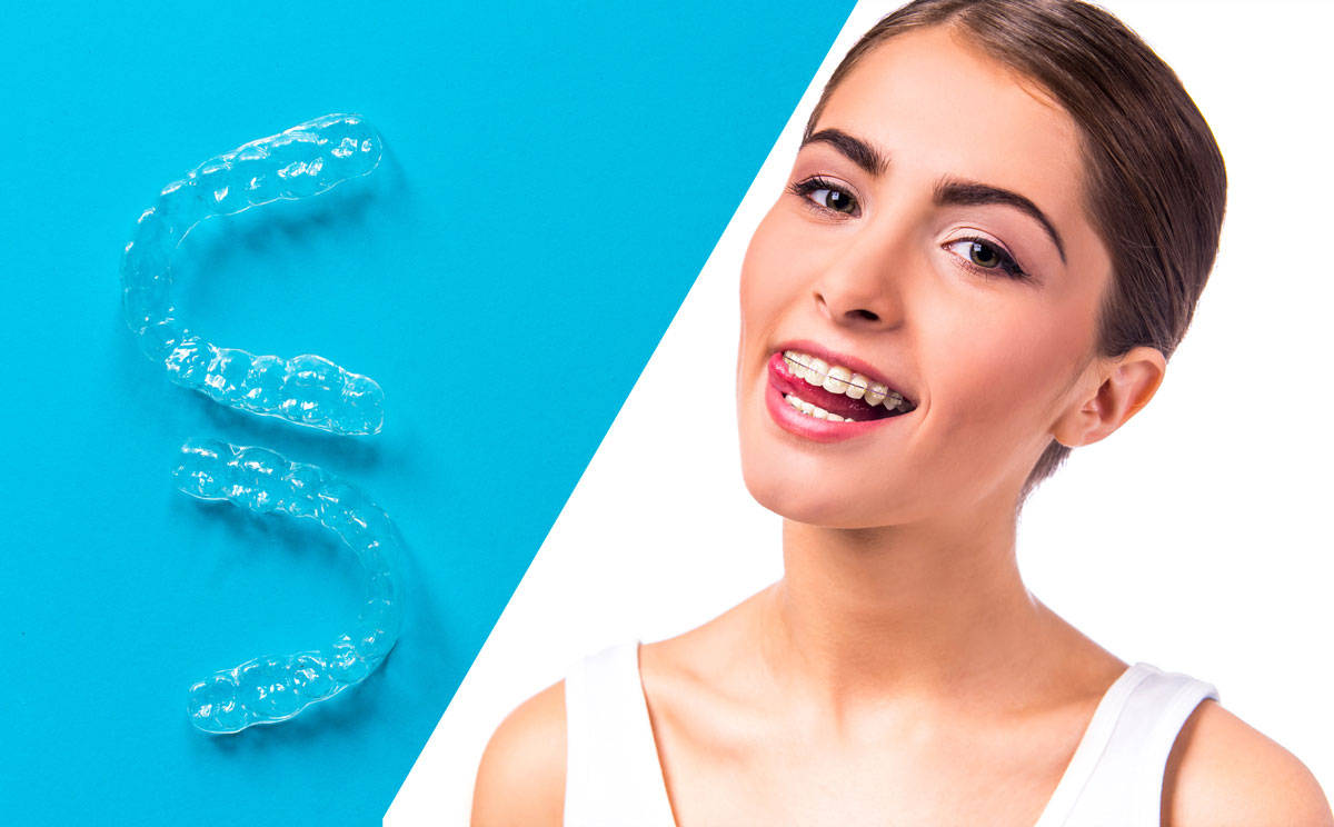 Choose the right clear braces