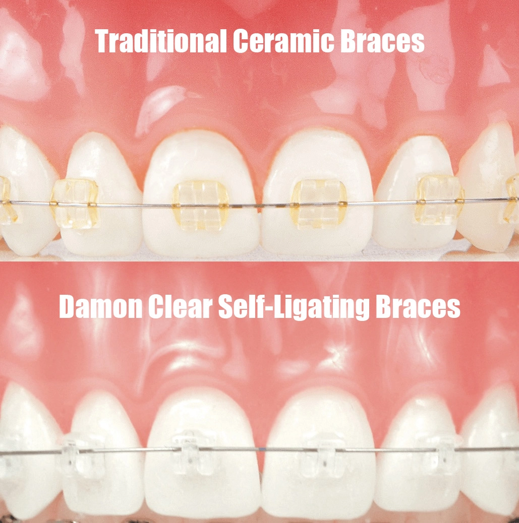 Damon clear vs ceramic braces