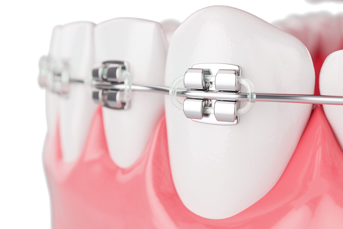 Brands and costs of traditional metal braces