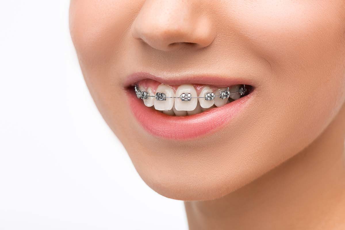 Overjet treated with traditional metal braces